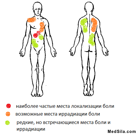 Места боли и иррадиции болей при холецистите